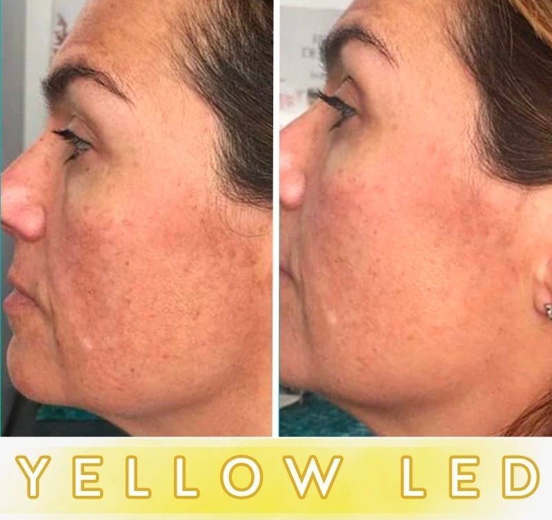 LED Anti-Ageing Mask Pro - Face