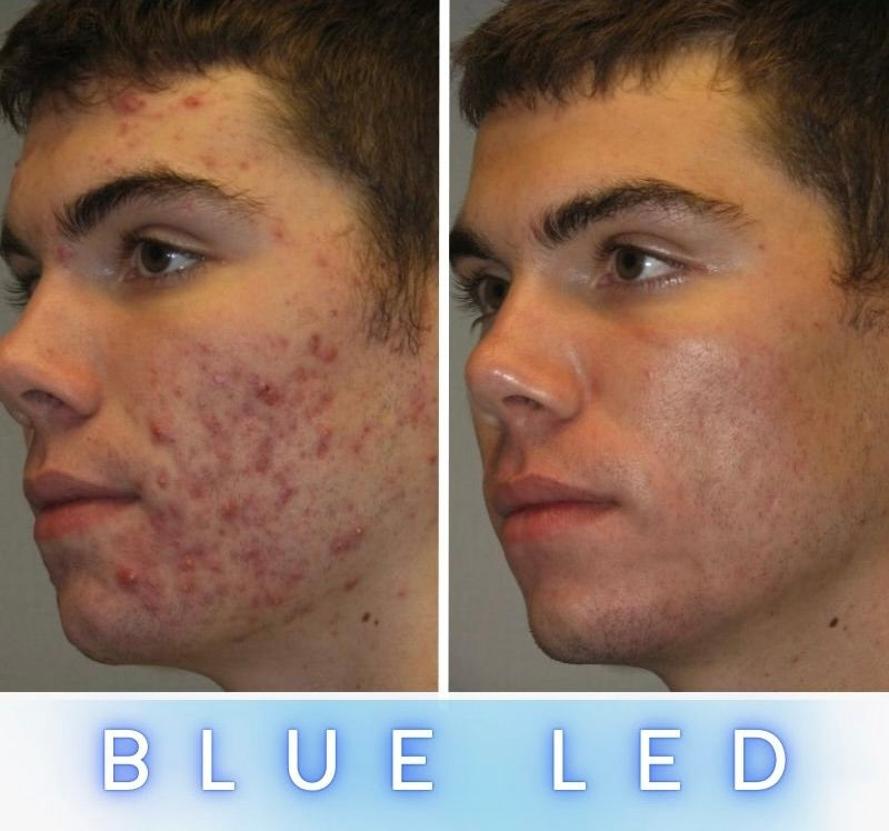 LED Anti-Ageing Mask Pro - Face