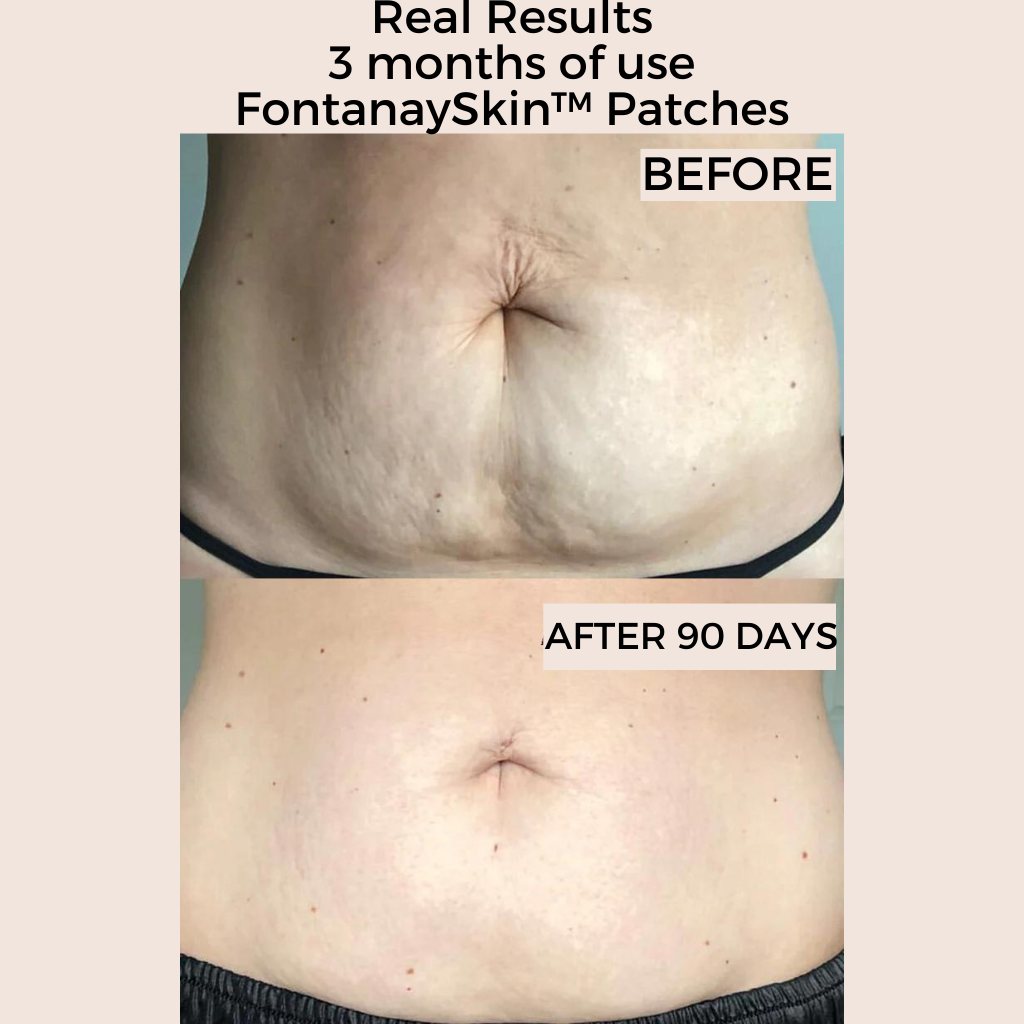 Stretch Marks & Cellulite Reusable Body Patches Fontanay™